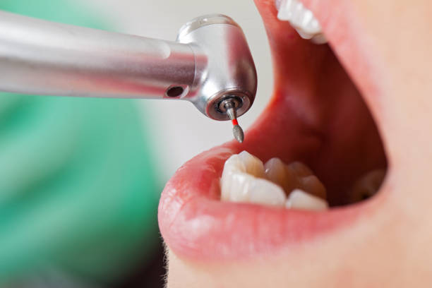 Best Chipped Tooth Repair Near Me  in Atlantis, FL